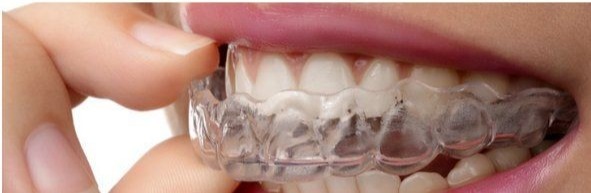 Alinhador Invisível Clear Correct